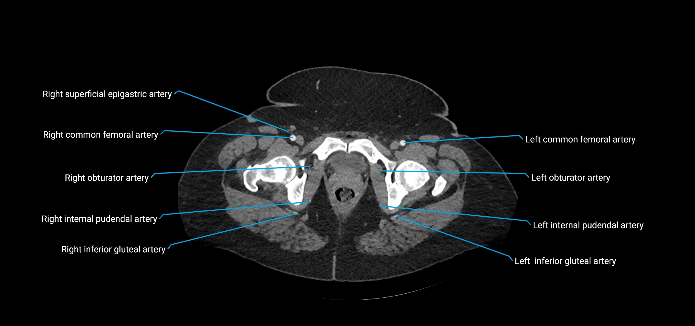 CTA abdomen axial cross sectional anatomy labelled image_256 (2).webp